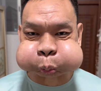 皇冠信用網代理占成
_广东一男子吹玻璃30年致腮帮变形皇冠信用網代理占成
,调侃自己是“青蛙王子”会蛤蟆功